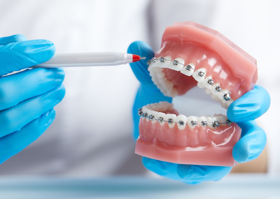 メタルブラケット