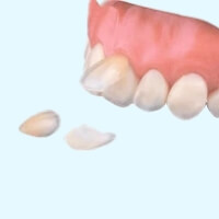 ラミネートベニア