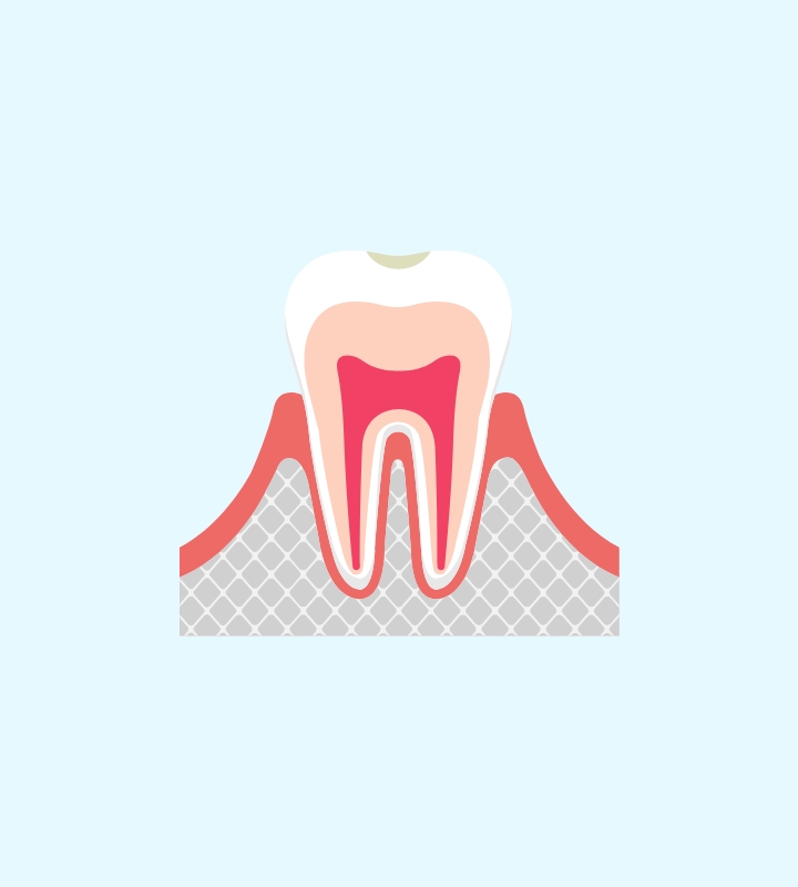 ごく初期の虫歯・要観察歯