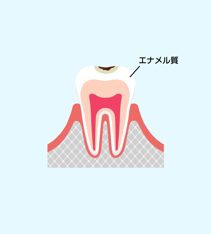 エナメル質の虫歯