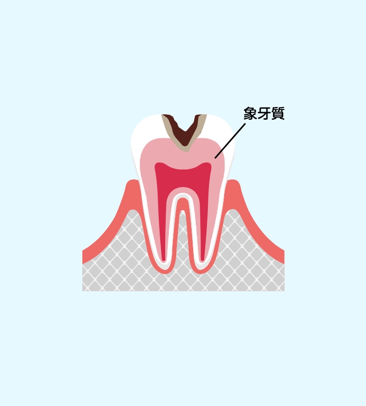 象牙質の虫歯