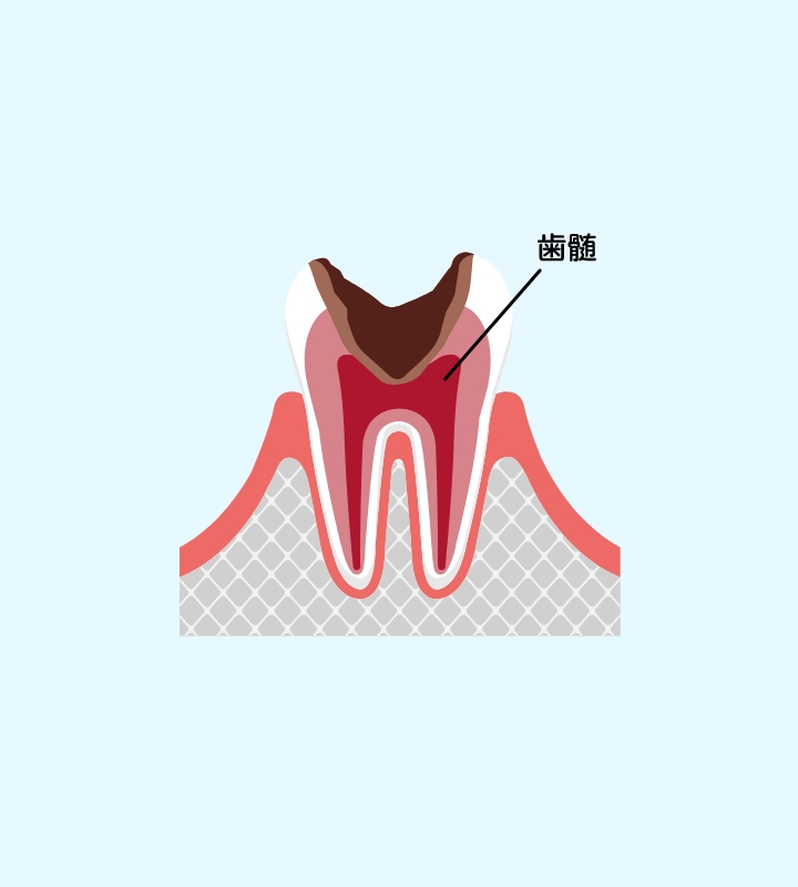 神経にまで侵食した虫歯