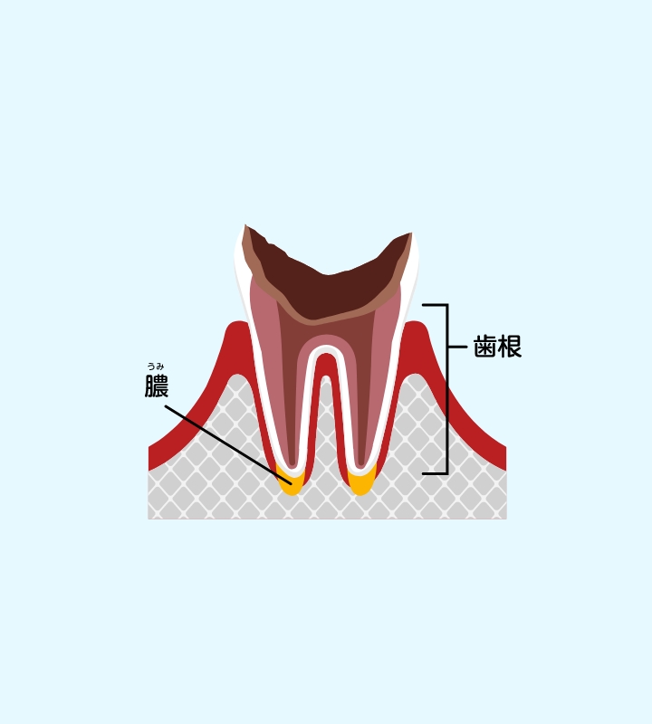 残根状態の虫歯