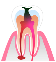 歯髄に細菌が侵入