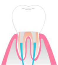 被せ物をセット
