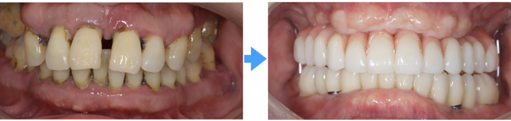 59歳男性の全顎インプラント治療症例|歯周病から上下12本埋入で噛める喜びを回復