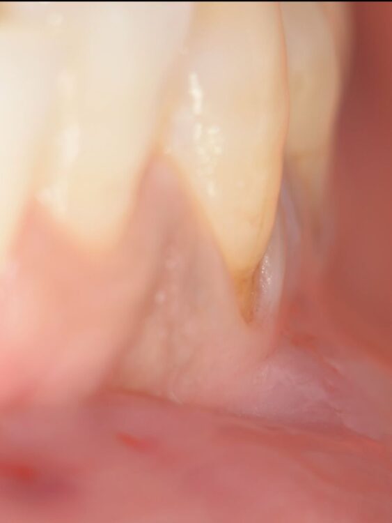 大阪梅田のカツベ歯科による、歯肉退縮の移植なし改善症例(術前)