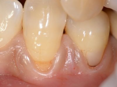 歯ぐきが下がってトラブル…③歯ぐきが下がったら「移植が絶対必要！」だと思ってませんか？