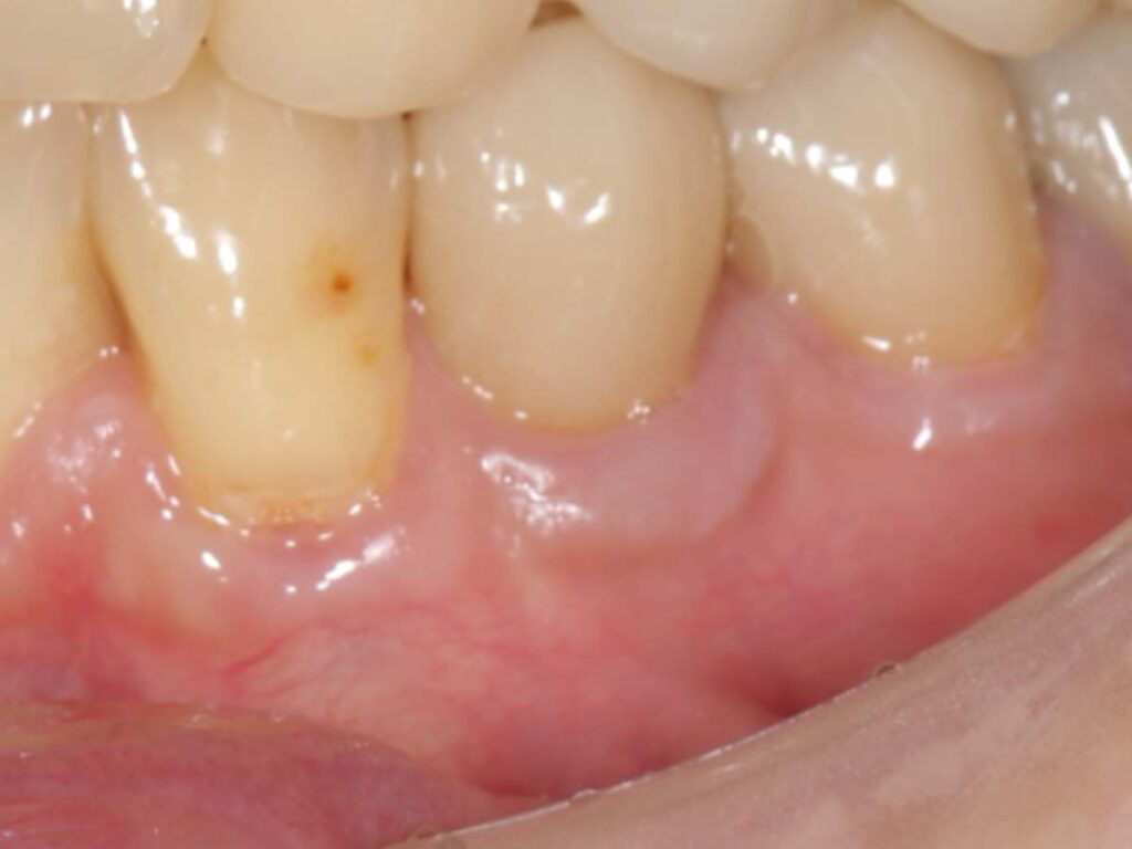 術後側方面観(術後10年以上経過)