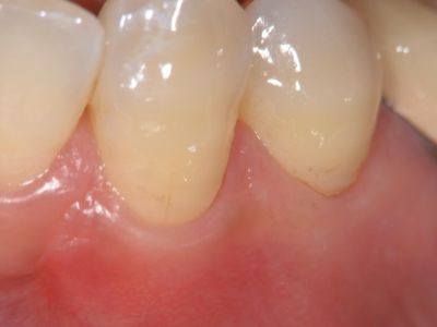 大阪梅田のカツベ歯科による、歯肉退縮の移植なし改善症例(術後)