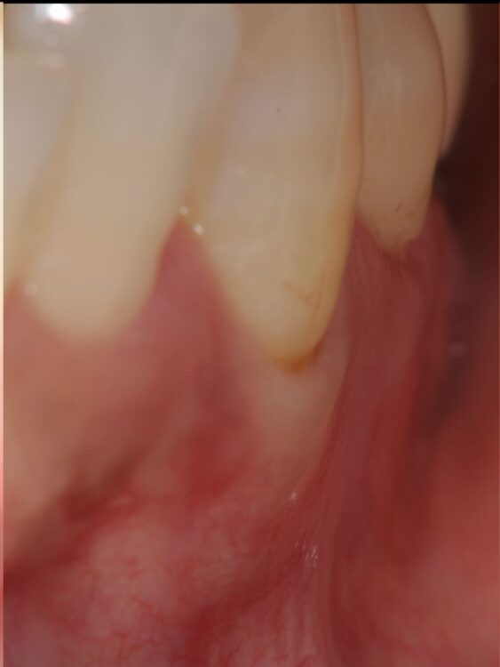 大阪梅田のカツベ歯科による、歯肉退縮の移植なし改善症例(術後)