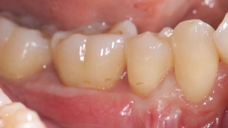 術後①奥歯の歯肉退縮症例