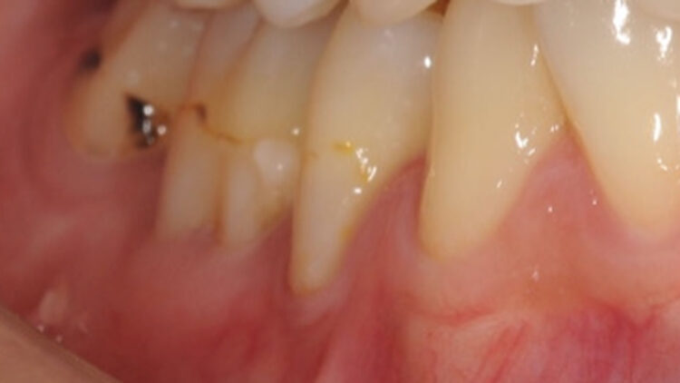 術前②奥歯の歯肉退縮症例