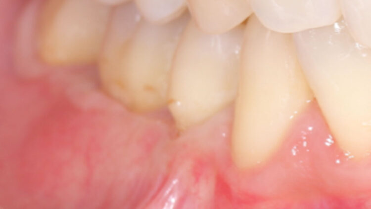 術後②奥歯の歯肉退縮症例