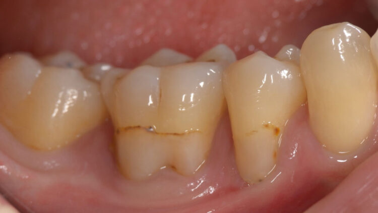 術前①奥歯の歯肉退縮症例